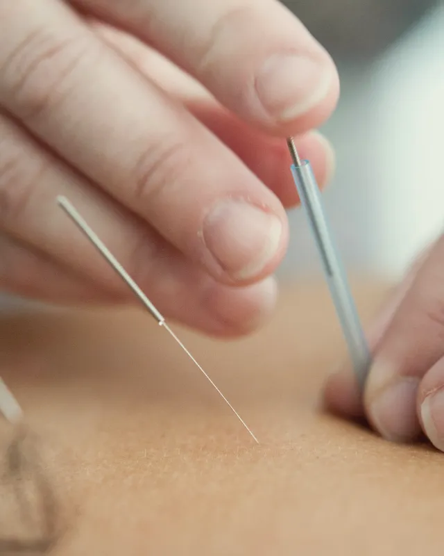 Fingers placing a fine, sterile needle into the skin of a client's back