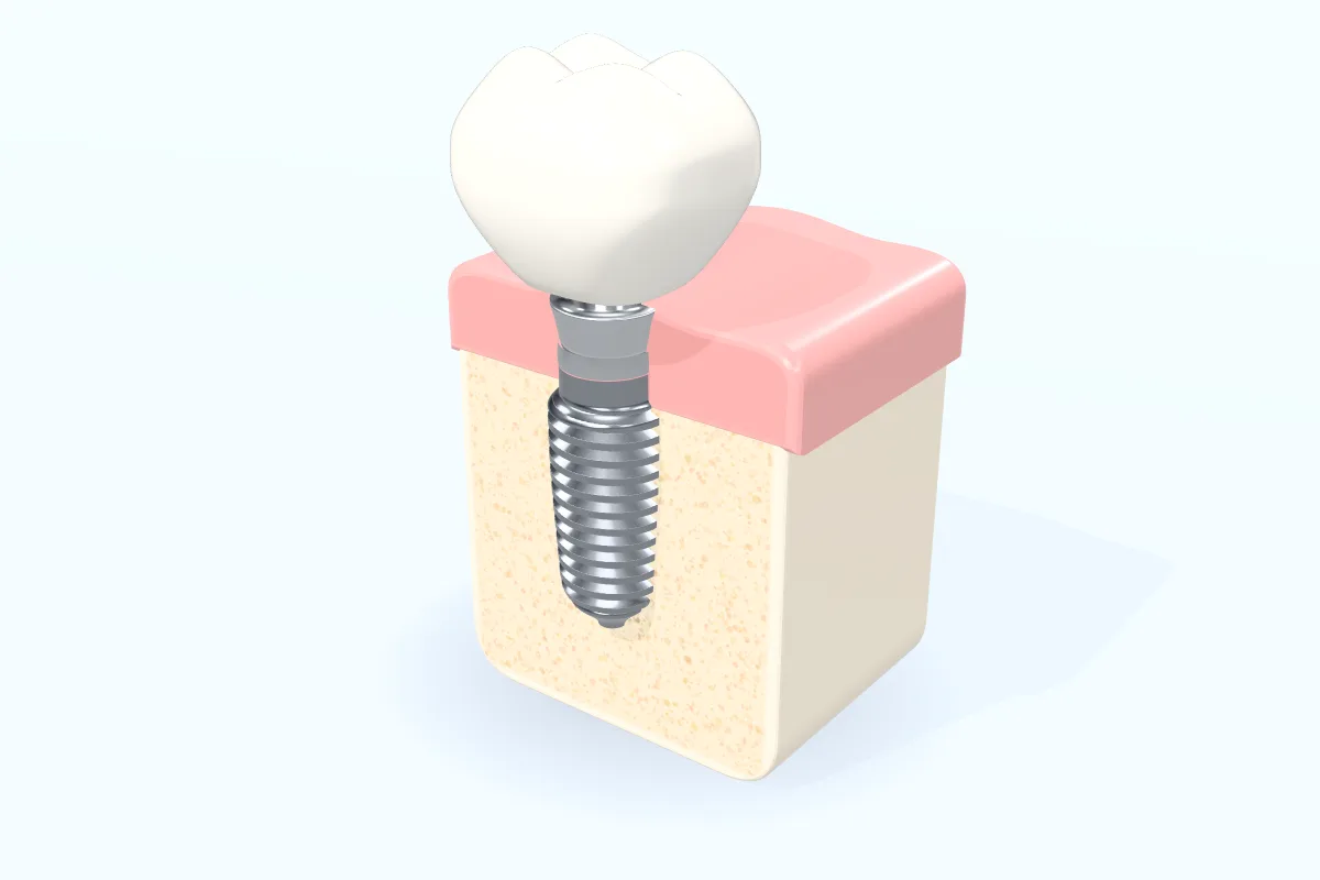 A model of a dental implant: a titanium post and abutment under a white crown, set in a cut-away of gum and bone